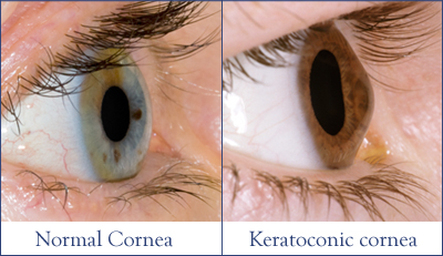 Keratoconus before and after